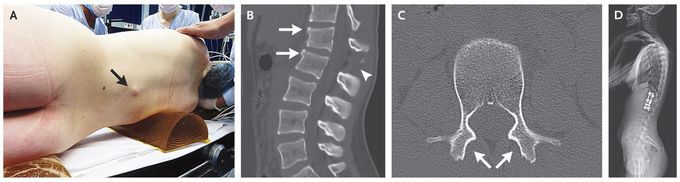 Spinal Fracture and a Widened Interspinous Gap