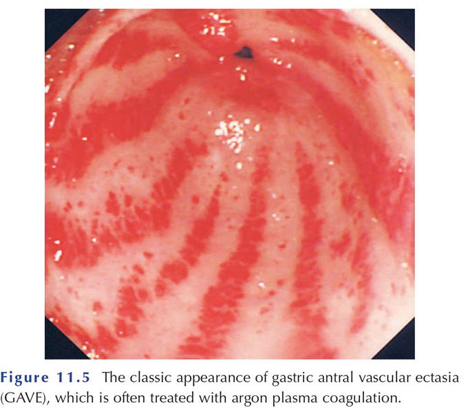 Gastric Antral vascular ecstasia