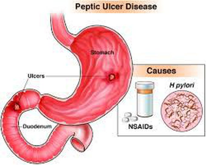 Peptic ulcers
