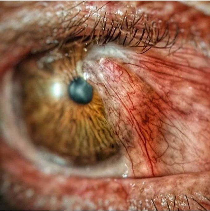 Pterygium