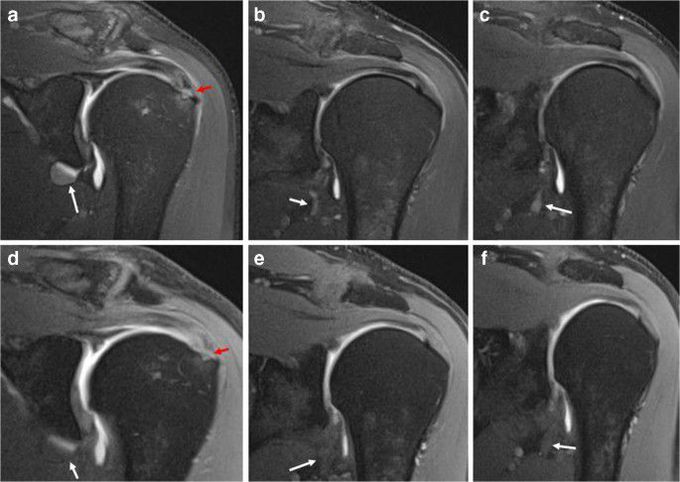 Indications of MR Arthroscopy