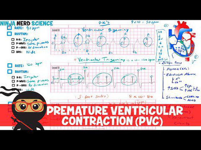 Premature Ventricular contraction