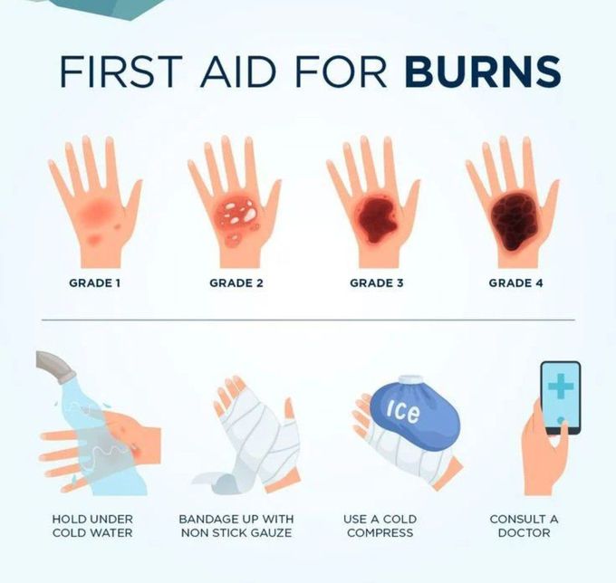 First Aid for Burns