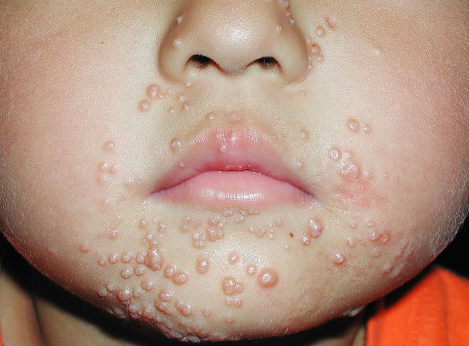 Papules