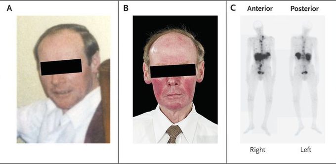 Intermittent Facial Flushing and Diarrhea