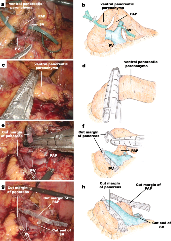 annular pancreas