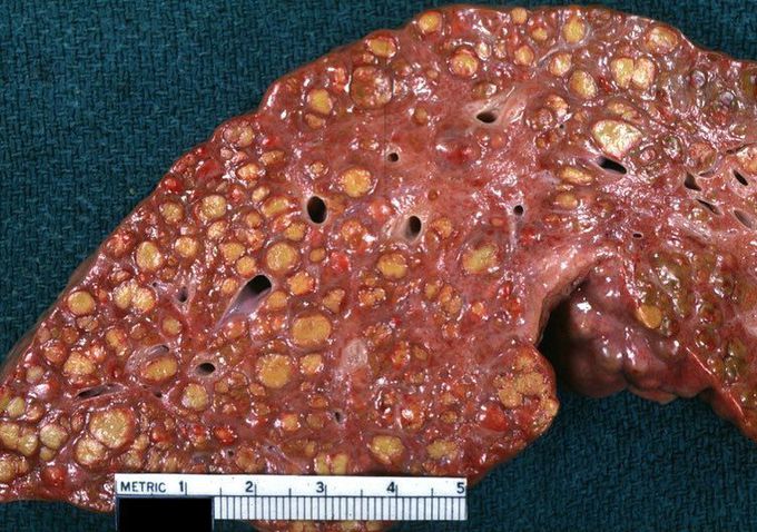 Macronodular Liver Cirrhosis
