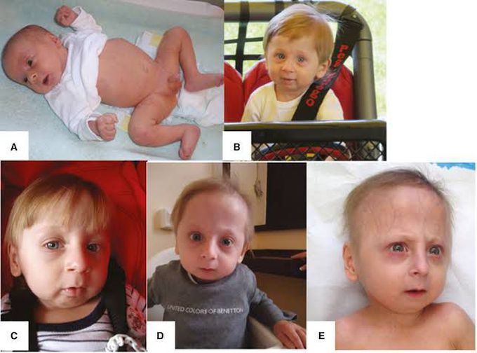 progeria syndrome babies