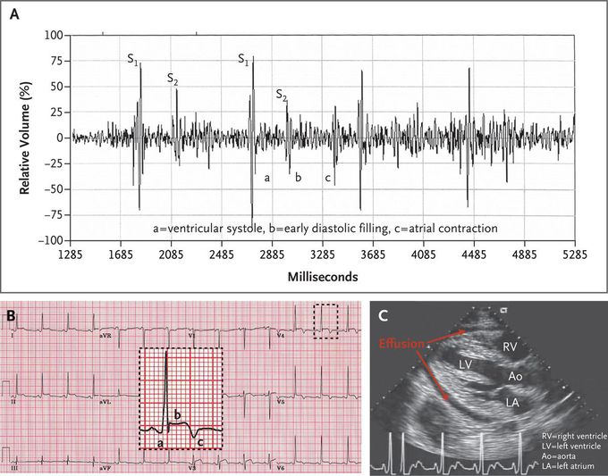 An Audible Case of Acute Pericarditis