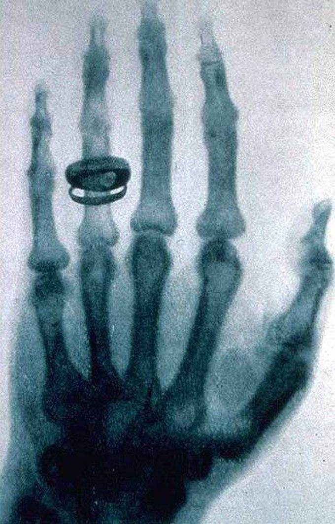 ✋🏻 x-ray