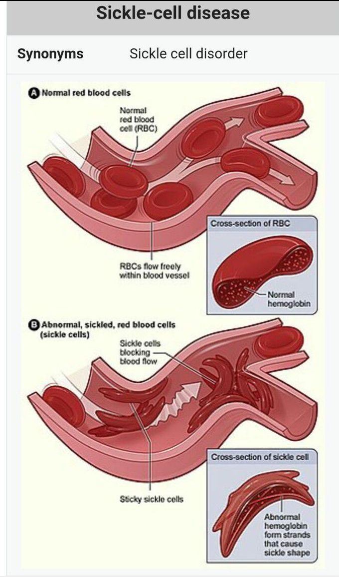 Sickle cell disease