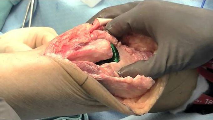 Total Elbow Replacement Surgery