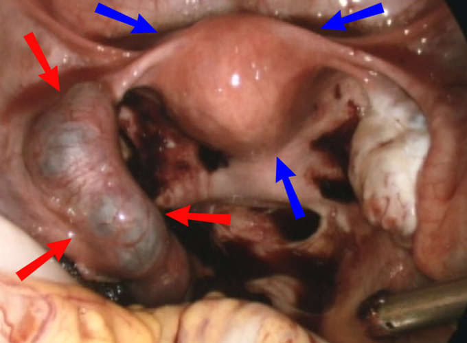 ectopic pregnancy