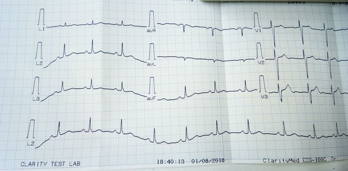 My ECG ♥ # how's this?
