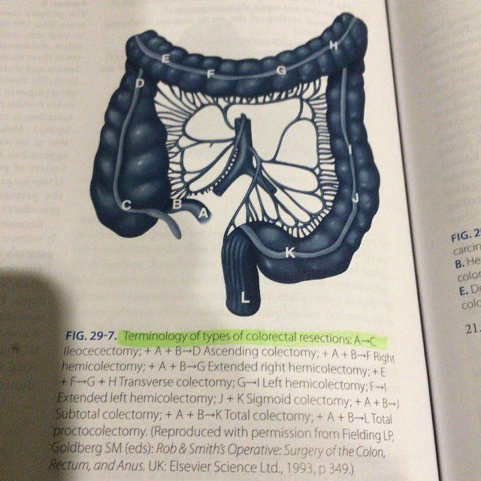 Type of colorectal resections