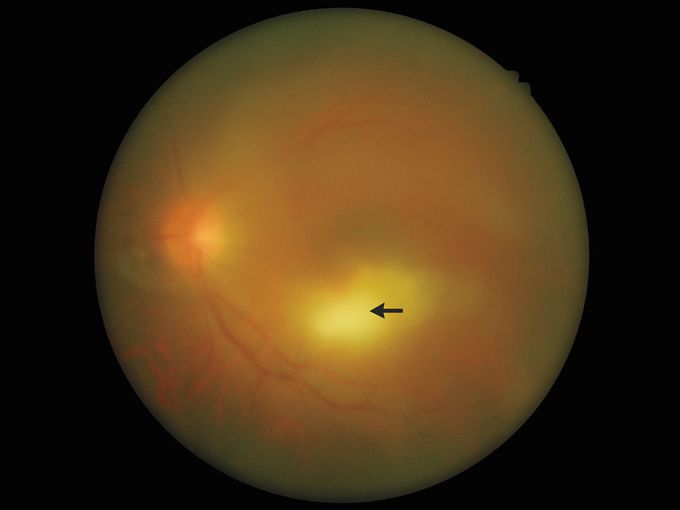 Acute Ocular Toxoplasmosis