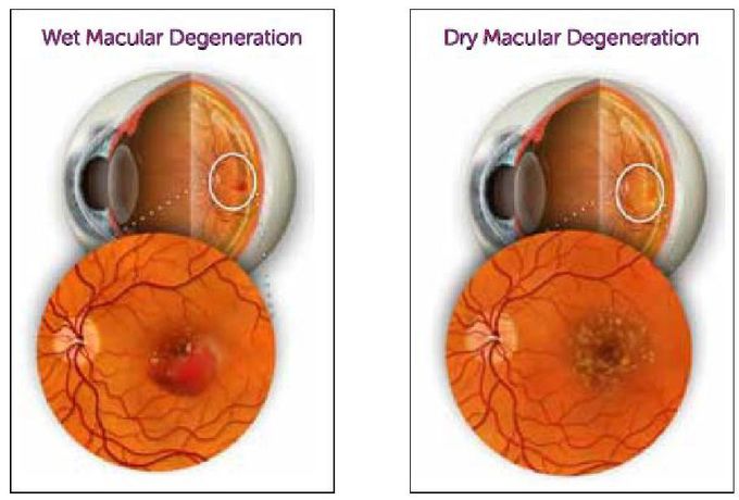 Types of Age-Related Macular Degeneration.