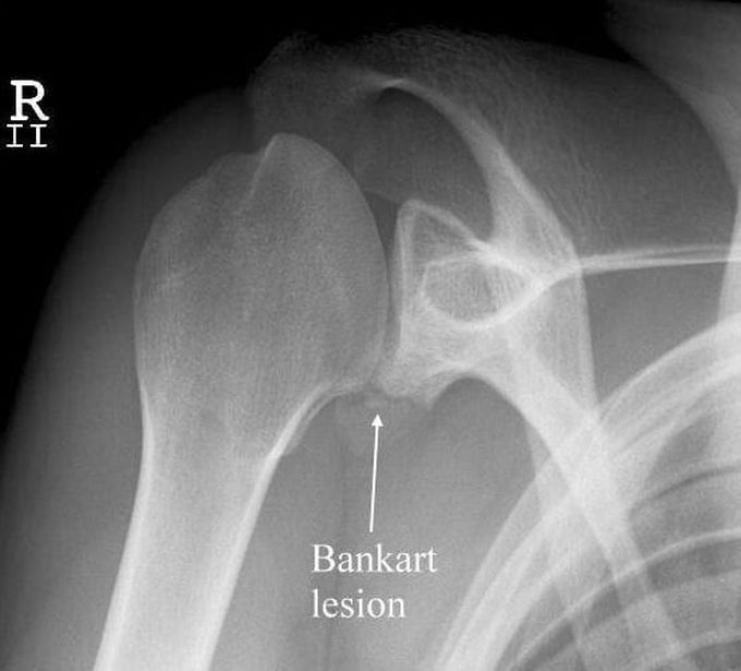 Bankart Lesion