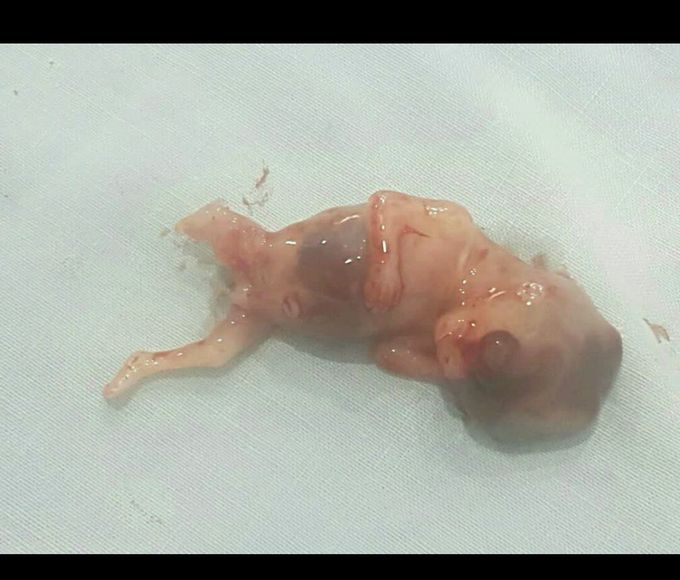 Case of miscarriage