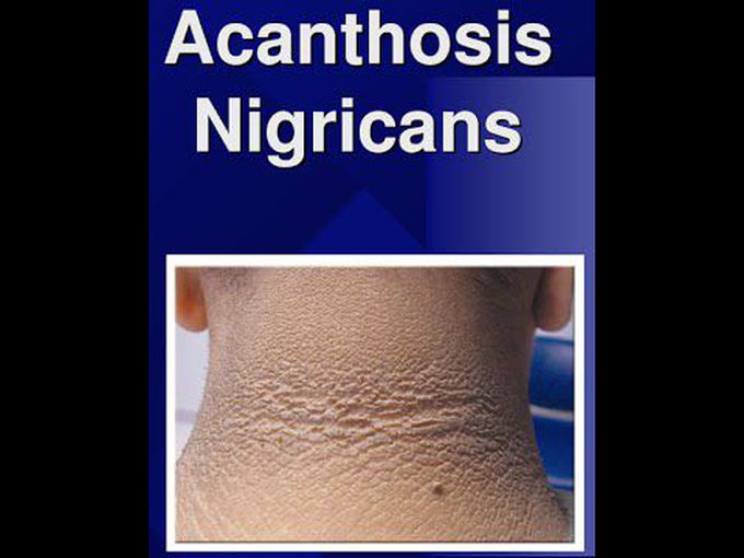 What are Acanthosis nigricans? Skin pathology series