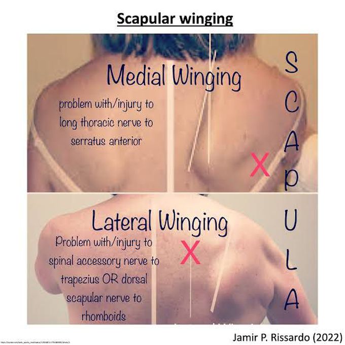 Scapular Winging