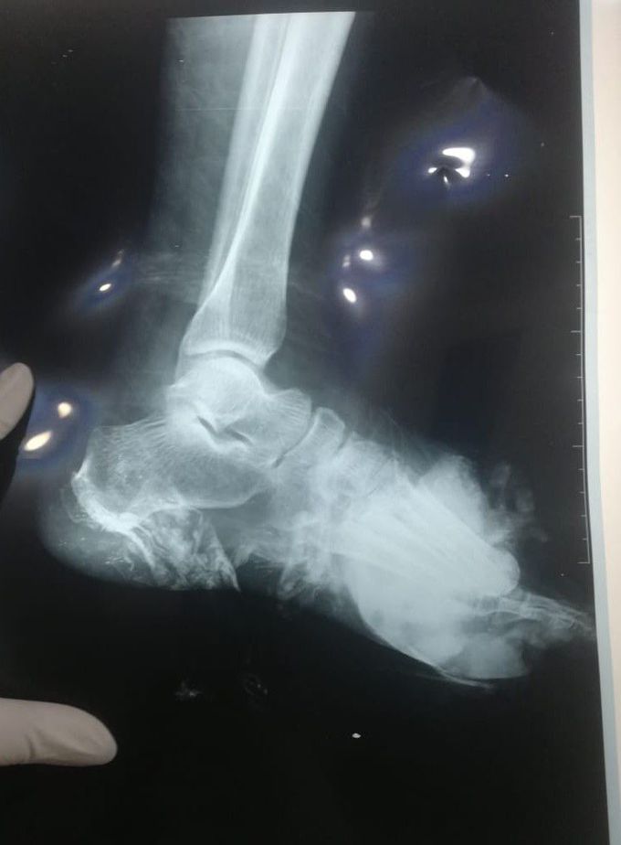 X_ray