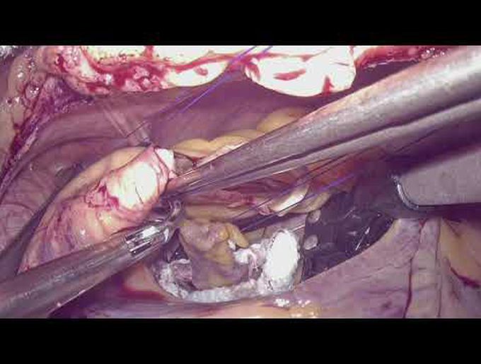 One-Inch Incision Totally Endoscopic AVR via a Lateral Approach