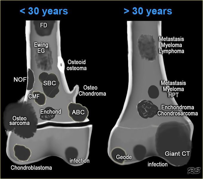 Bone tumors - MEDizzy