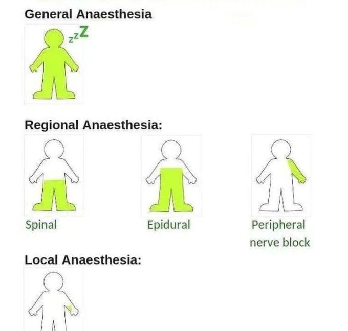 Types of Anesthesia