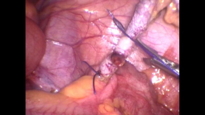 Laparoscopic appendectomy