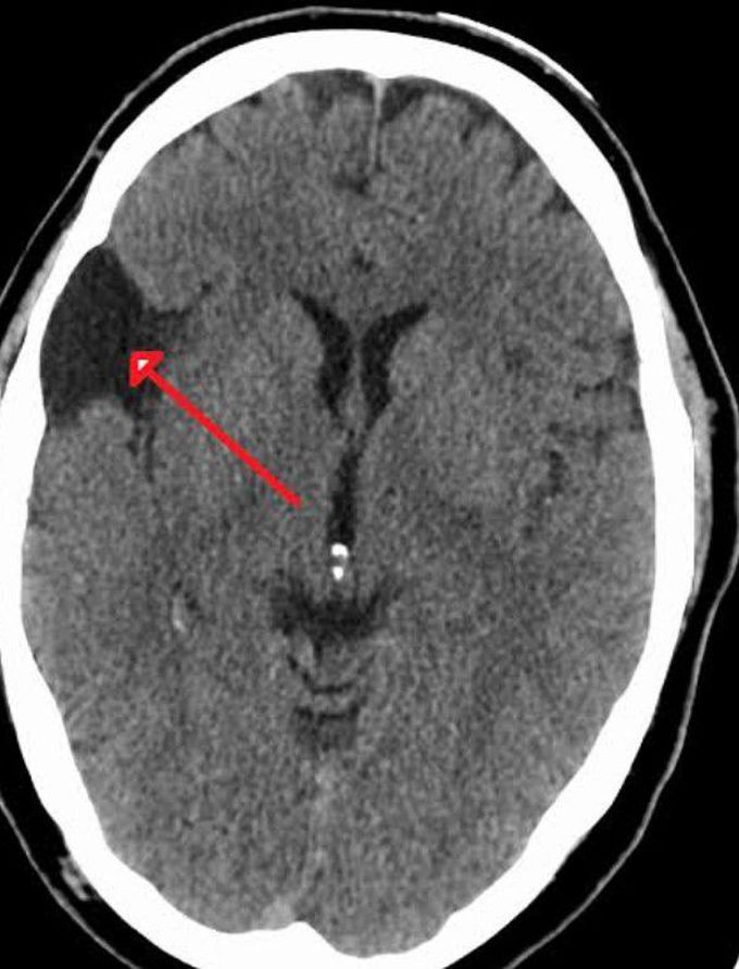 Symptoms of Arachnoid cysts