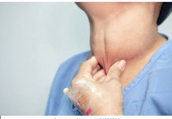 Goiter