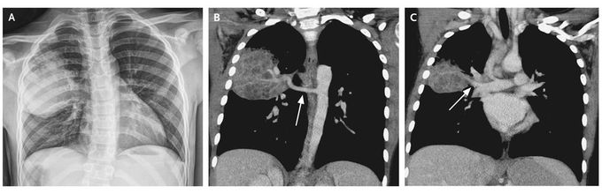 Pulmonary Sequestration