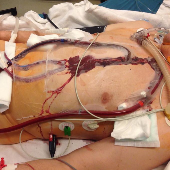 Extracorporeal Membrane Oxygenation