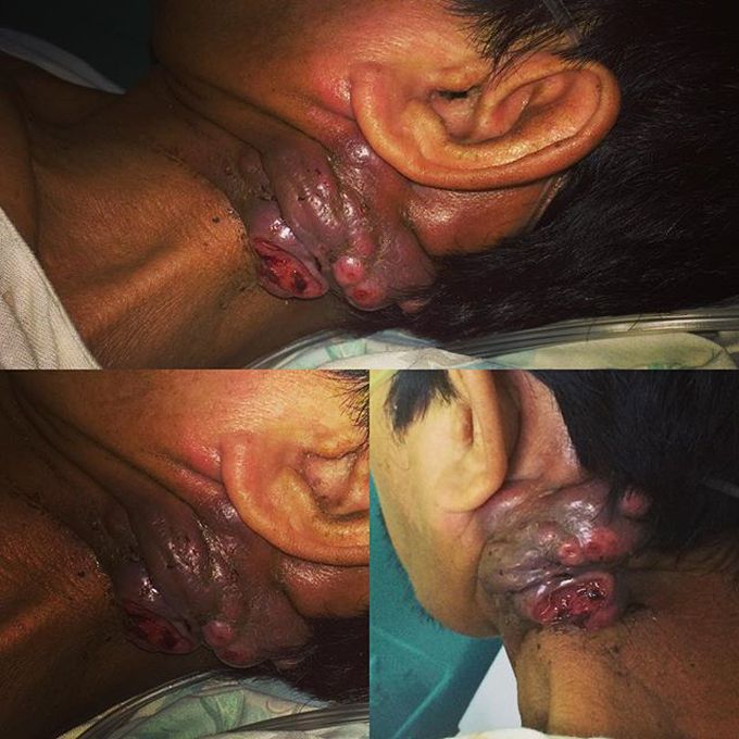 Neck tumor