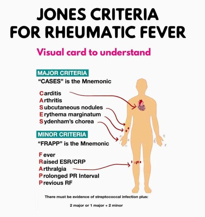 Jones Criteria