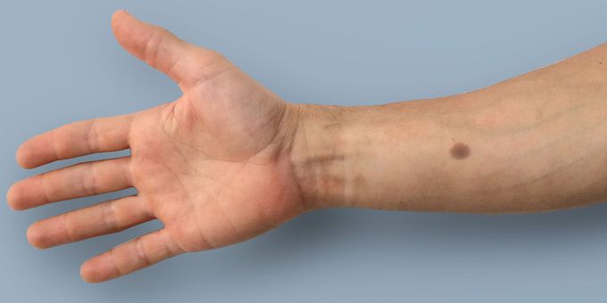 An artificial mole as an early warning sign