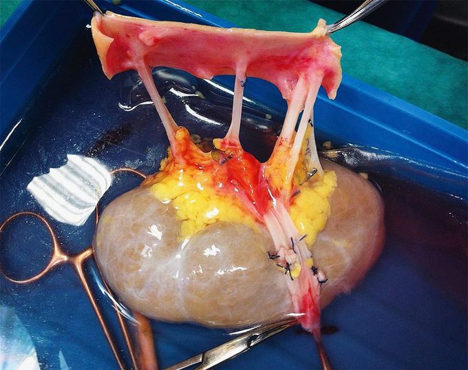 Multiple renal arteries!! 