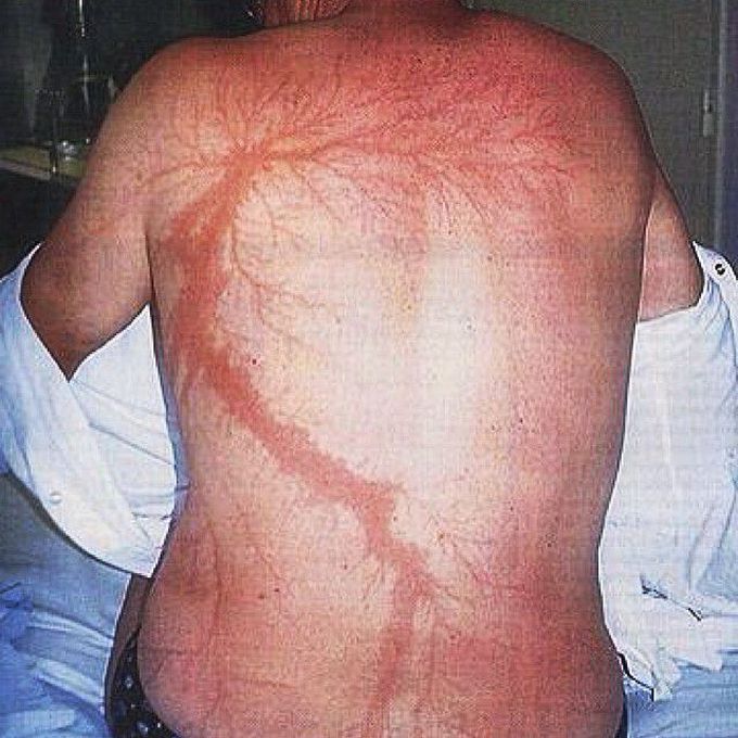 The back of a man who was struck by lightning