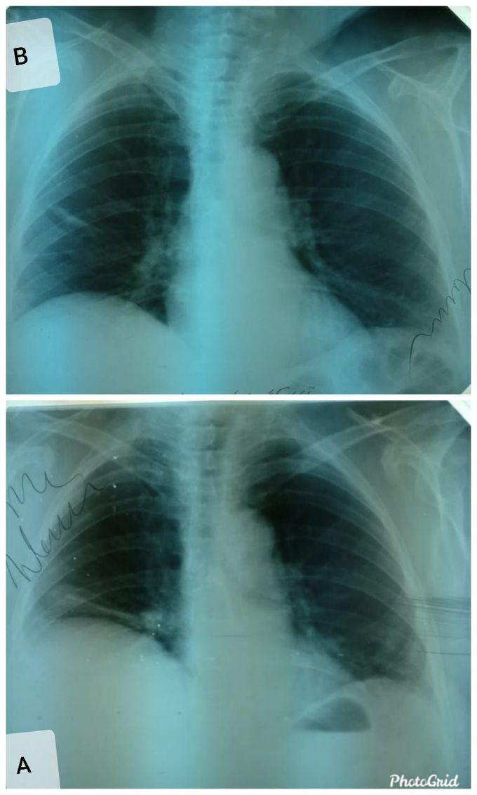 pneumonia