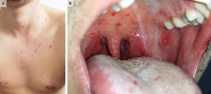 Acute Human Immunodeficiency Virus Infection