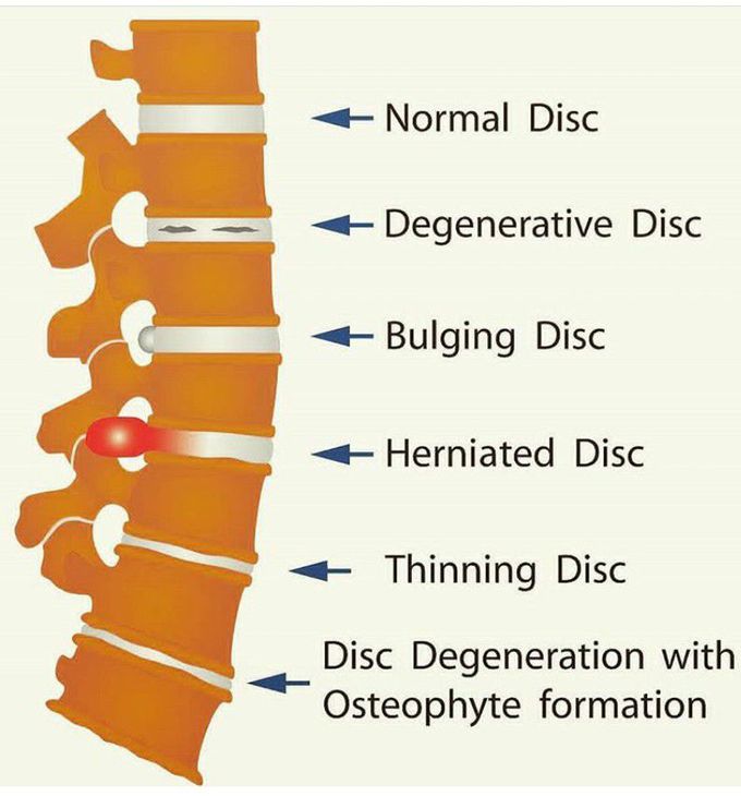 Types of disc