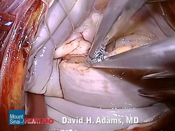 Mitral Valve Repair of Bileaflet Prolapse