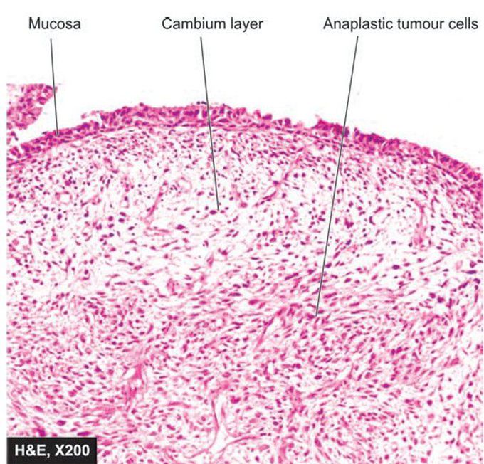 Botryoid rhabdomyosarcoma