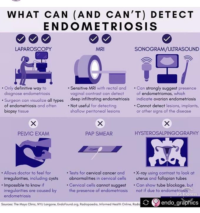 Endometriosis