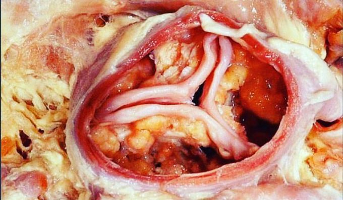 Picture depicting a stenosed Aortic valve
