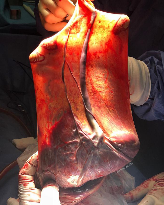 Fresh placenta shortly after delivery