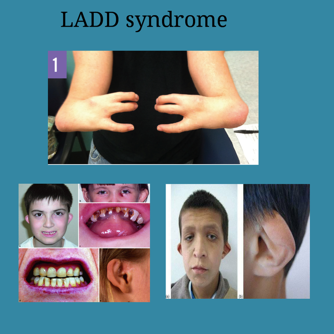 LADD SYNDROME