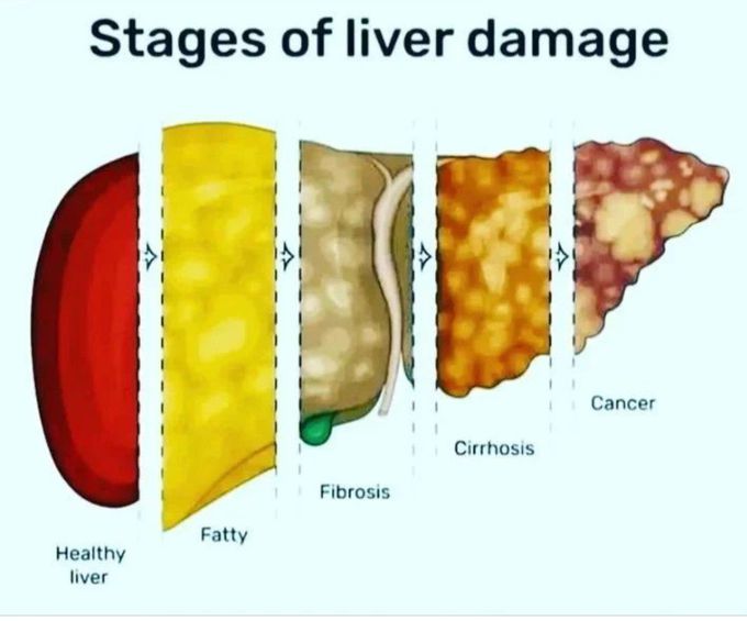 Stages of Liver Damage