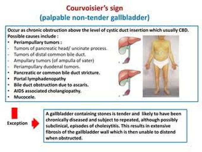 Courvoisier's sign